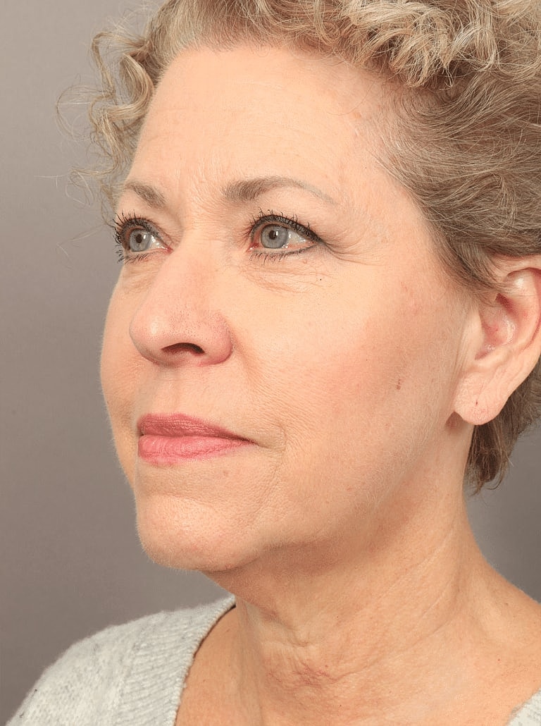 Neck Lift Before & After