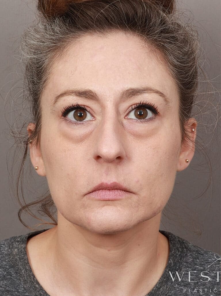 Neck Lift Before & After