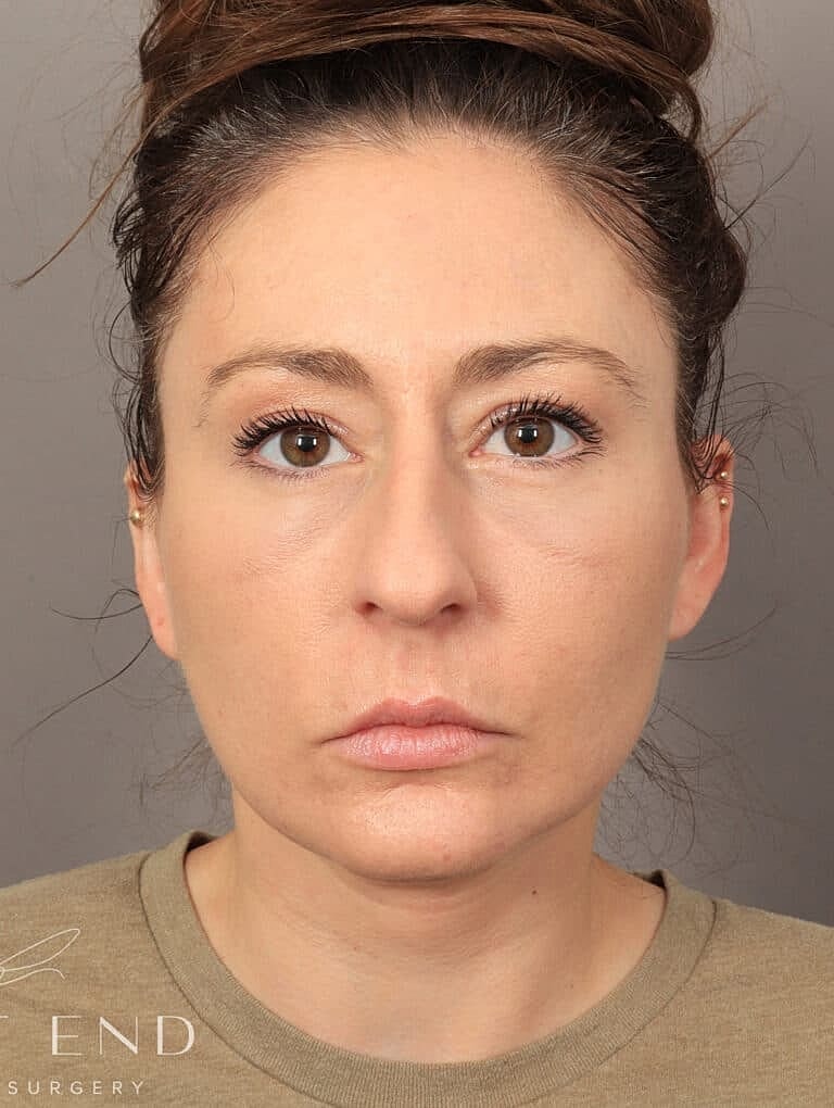 Neck Lift Before & After
