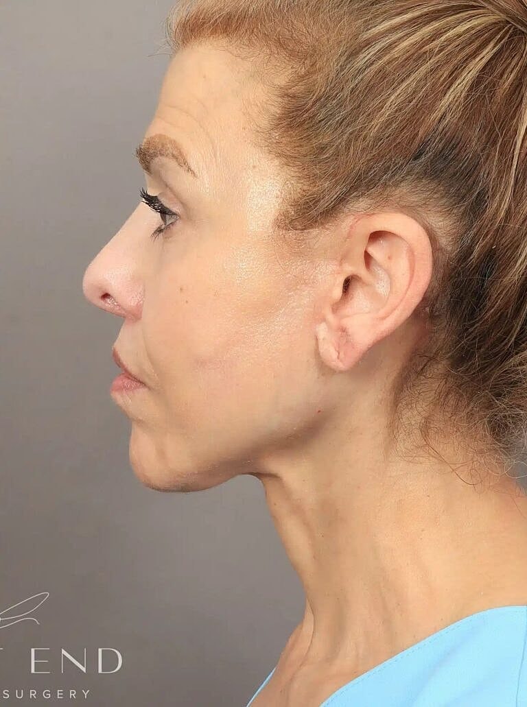 Neck Lift Before & After
