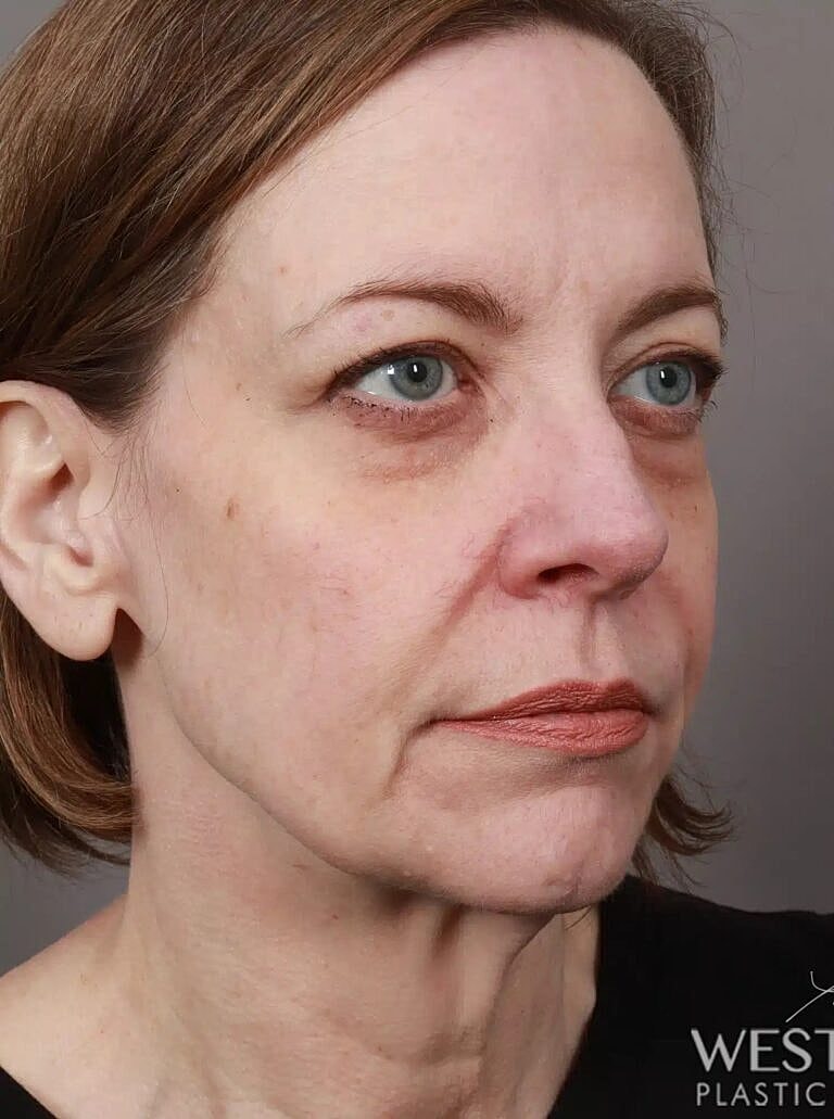 Neck Lift Before & After