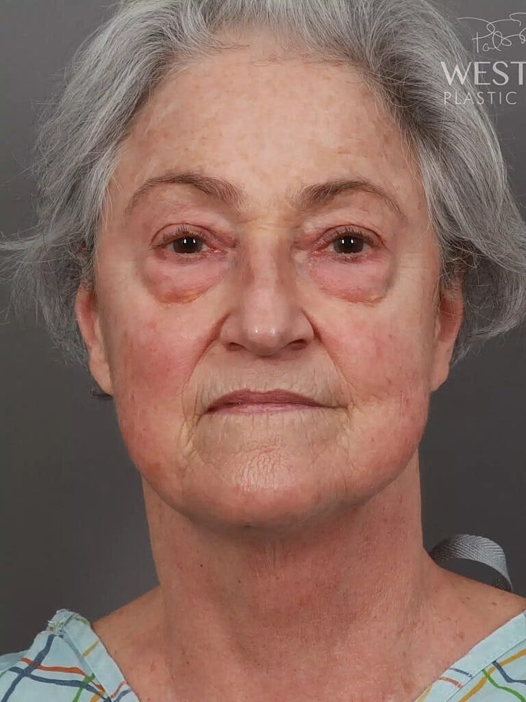 Neck Lift Before & After