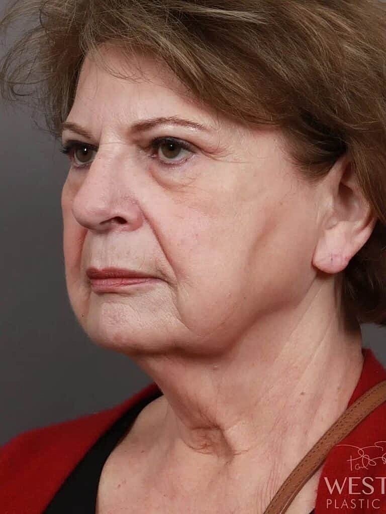 Neck Lift Before & After