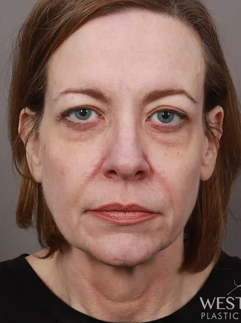 Neck Lift Before & After