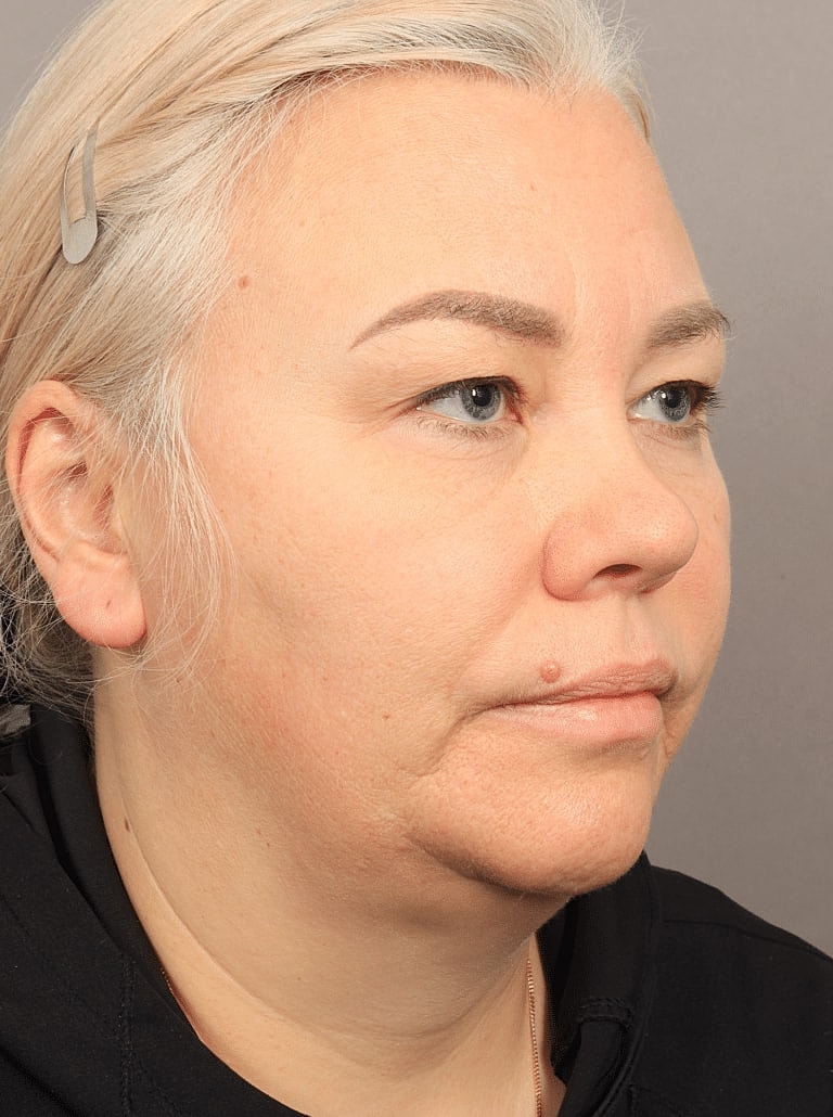 Neck Lift Before & After