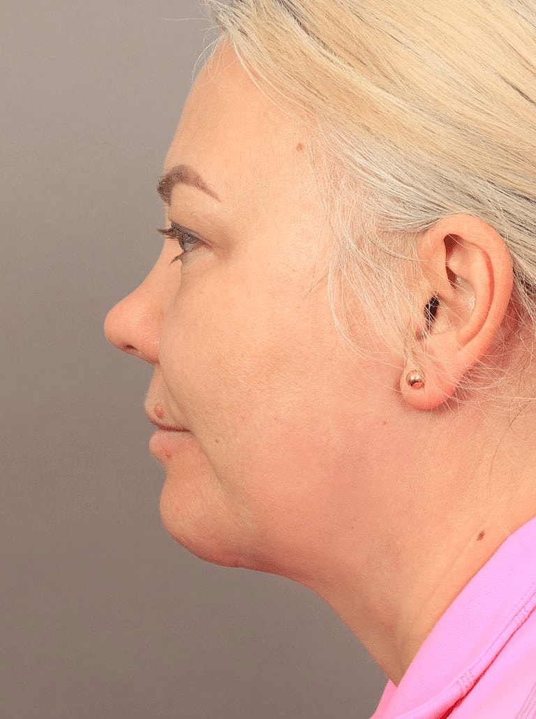 Neck Lift Before & After