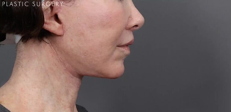 Neck Lift Before & After