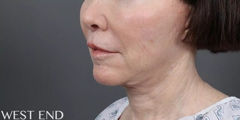 Neck Lift Before & After