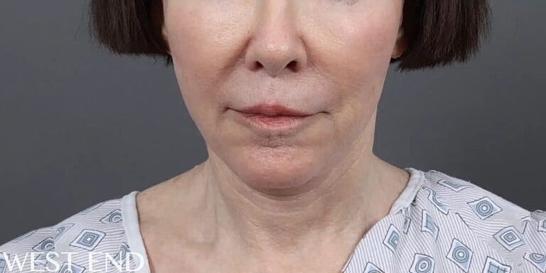 Neck Lift Before & After