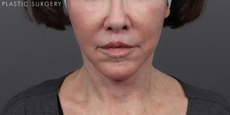 Neck Lift Before & After