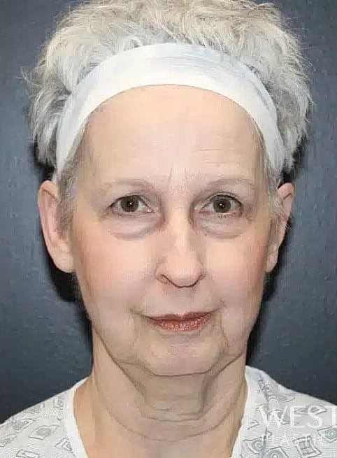 Neck Lift Before & After