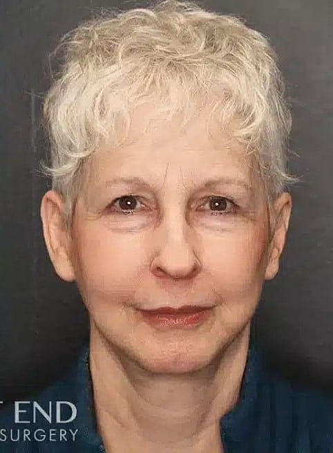 Neck Lift Before & After
