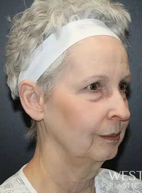 Neck Lift Before & After