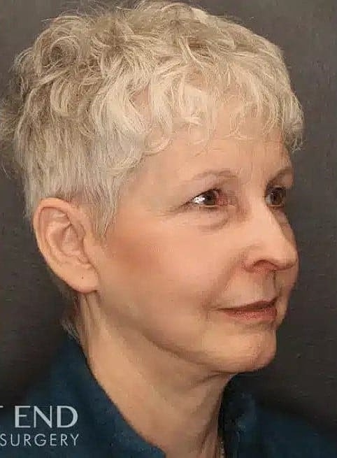 Neck Lift Before & After