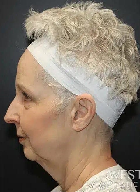 Neck Lift Before & After