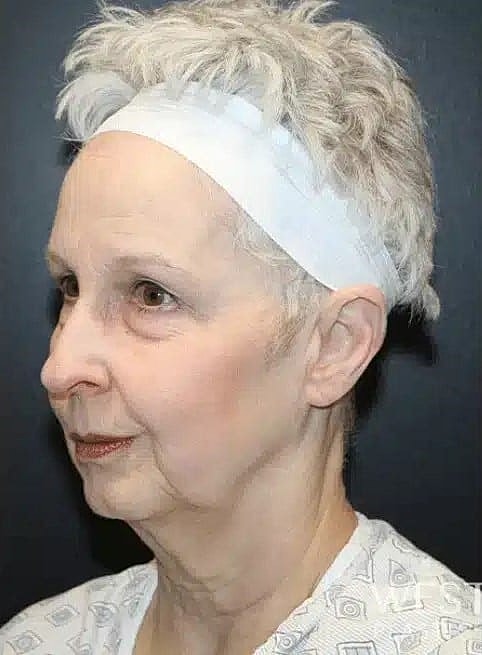 Neck Lift Before & After