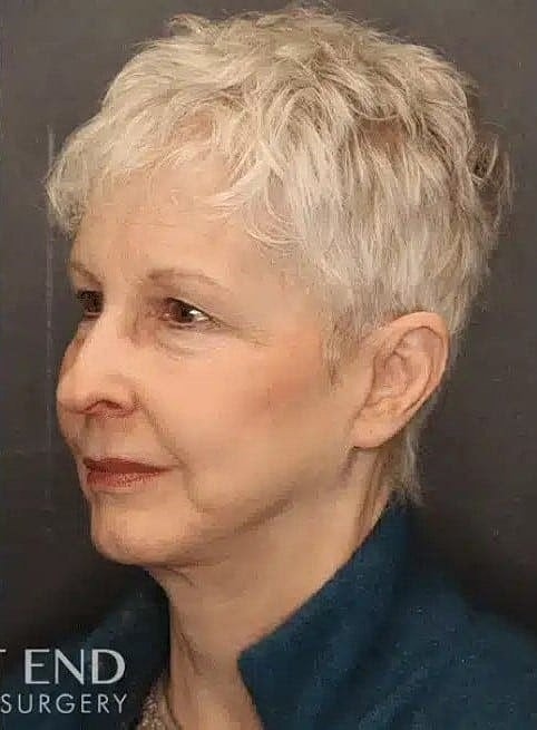 Neck Lift Before & After
