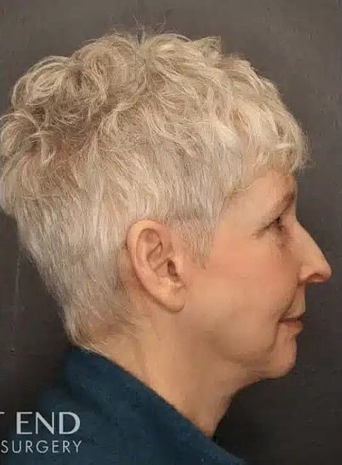 Neck Lift Before & After