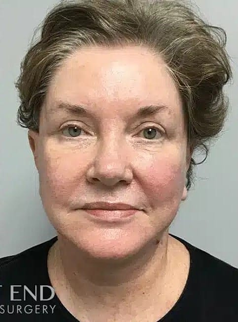 Neck Lift Before & After