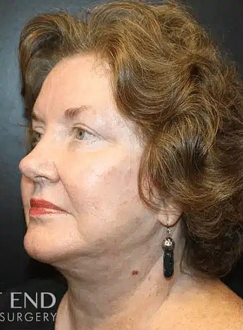 Neck Lift Before & After