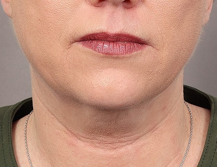 Neck Lift Before & After