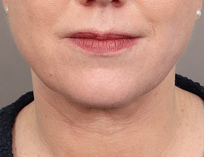 Neck Lift Before & After