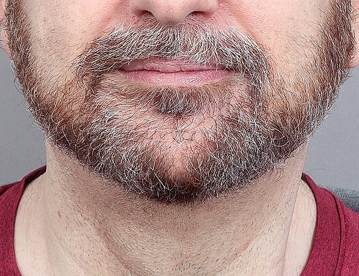 Neck Lift Before & After
