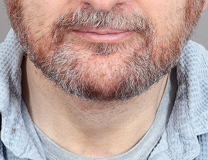 Neck Lift Before & After