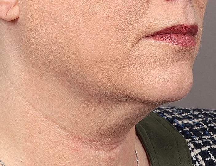 Neck Lift Before & After