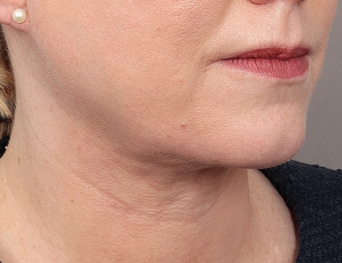 Neck Lift Before & After