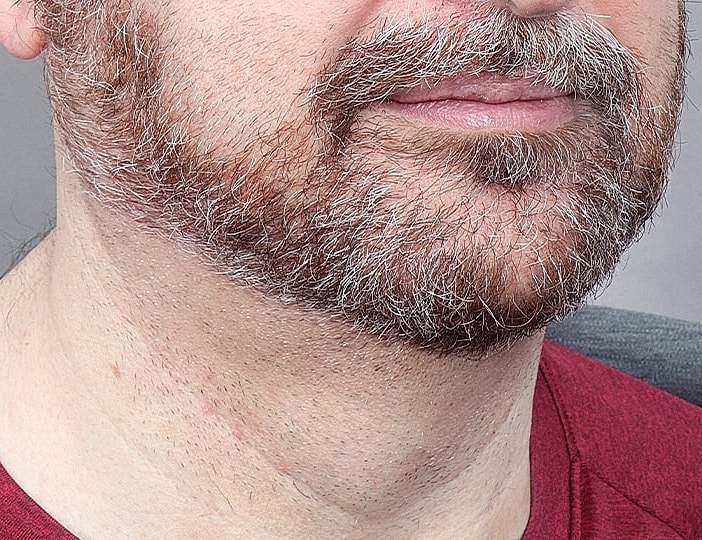 Neck Lift Before & After