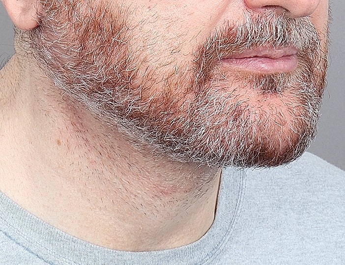 Neck Lift Before & After
