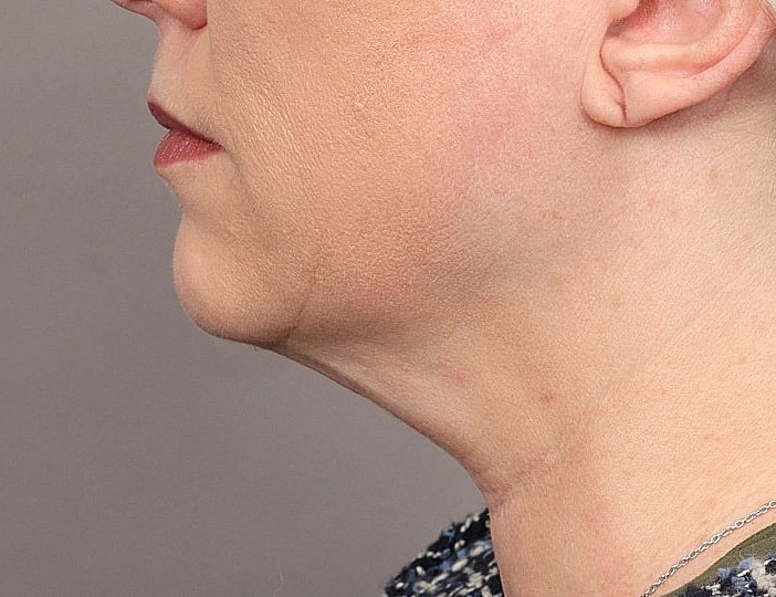 Neck Lift Before & After