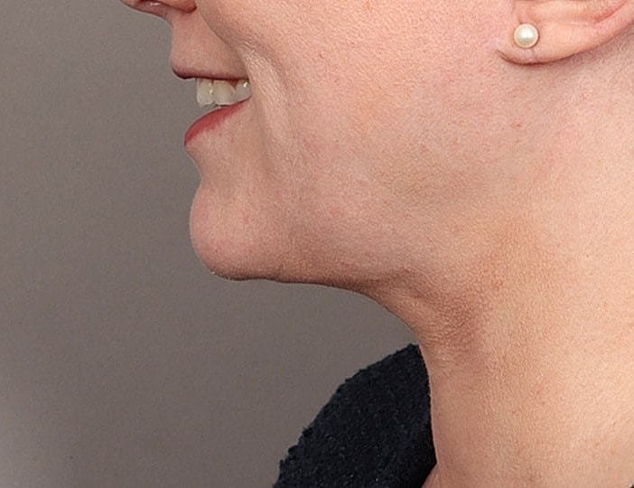 Neck Lift Before & After