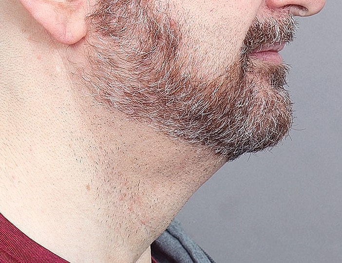 Neck Lift Before & After