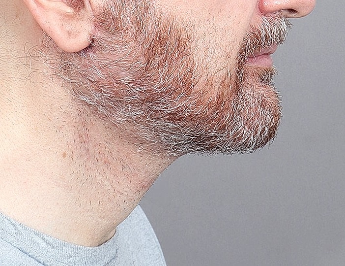 Neck Lift Before & After