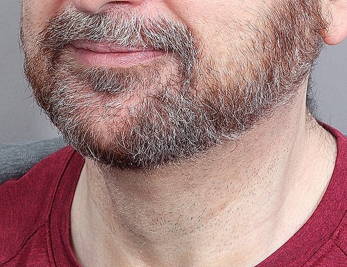Neck Lift Before & After