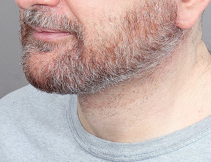 Neck Lift Before & After