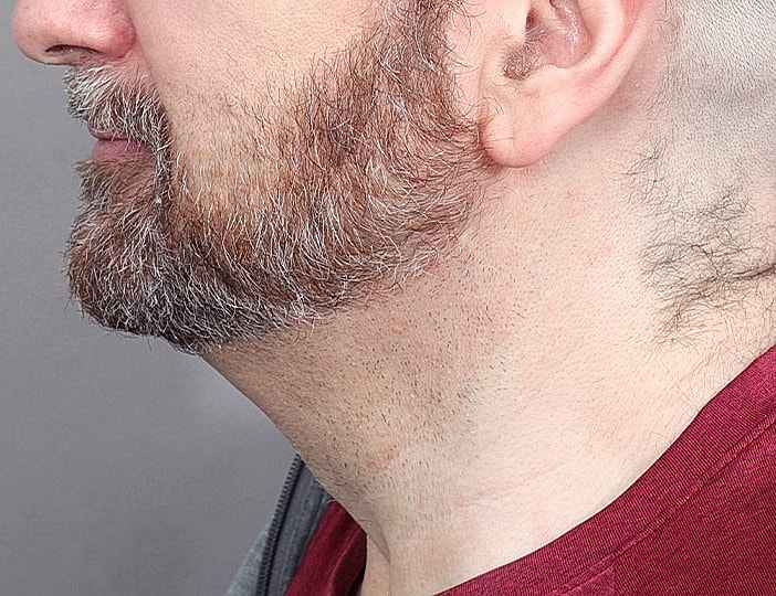 Neck Lift Before & After
