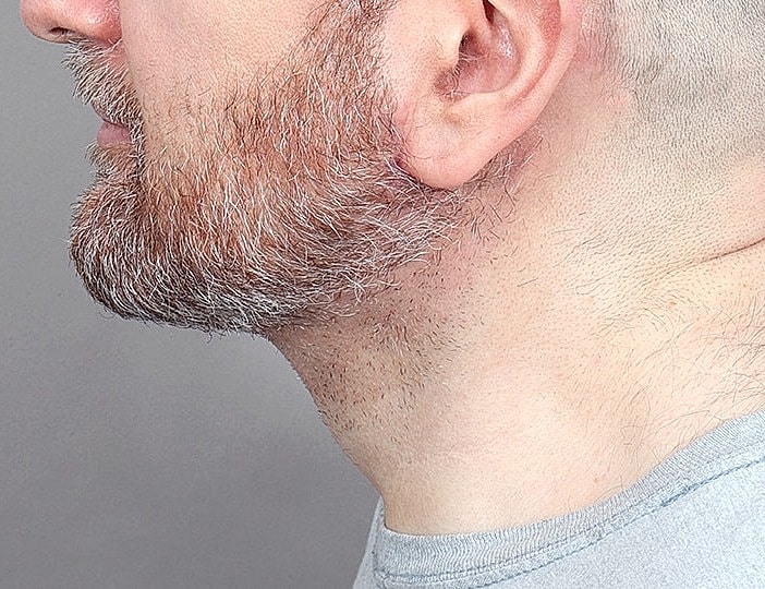 Neck Lift Before & After