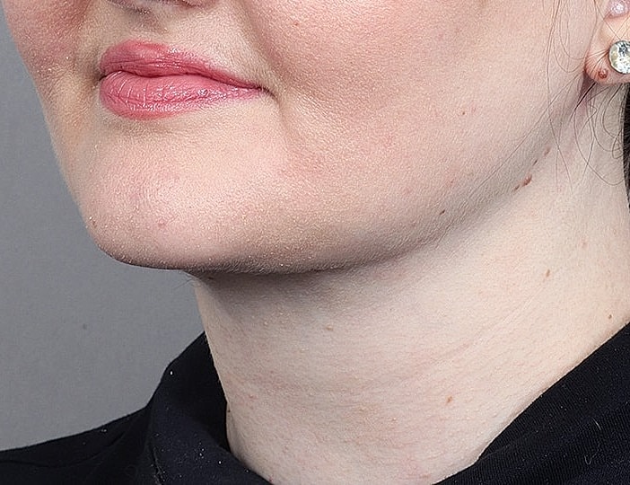 Neck Lift Before & After