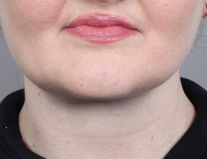 Neck Lift Before & After