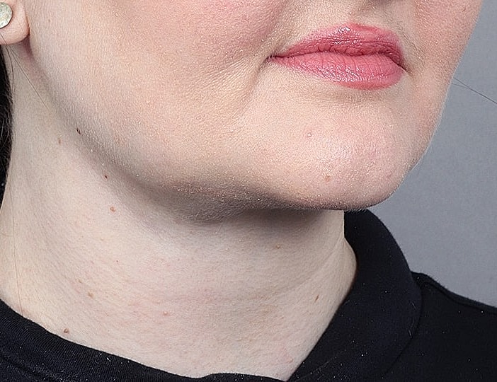 Neck Lift Before & After