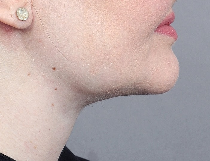 Neck Lift Before & After