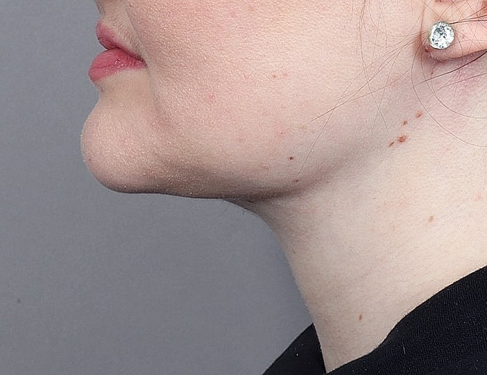 Neck Lift Before & After