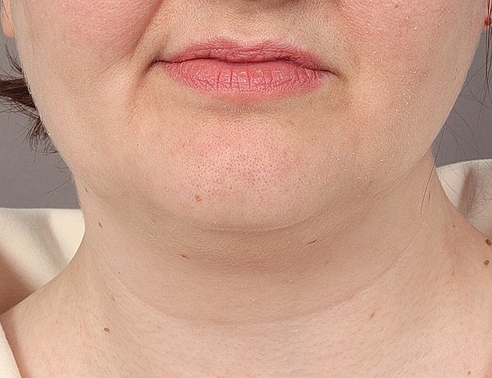 Neck Lift Before & After