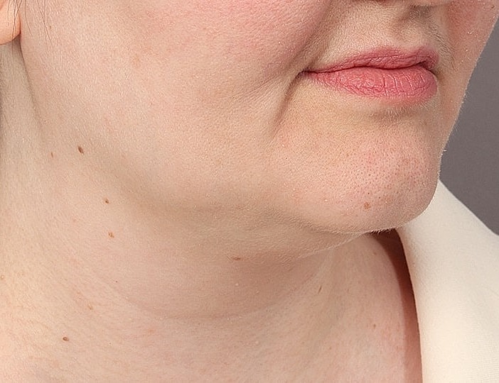 Neck Lift Before & After