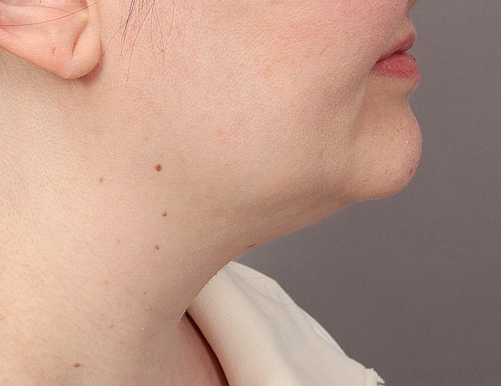 Neck Lift Before & After