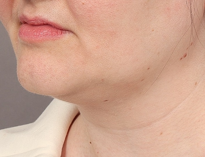 Neck Lift Before & After