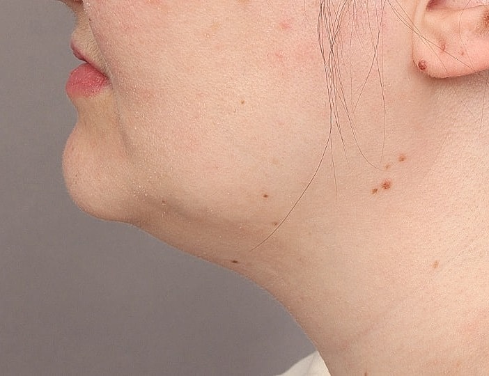 Neck Lift Before & After
